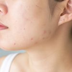 Bobos : causes, traitements et conseils pour les soulager efficacement