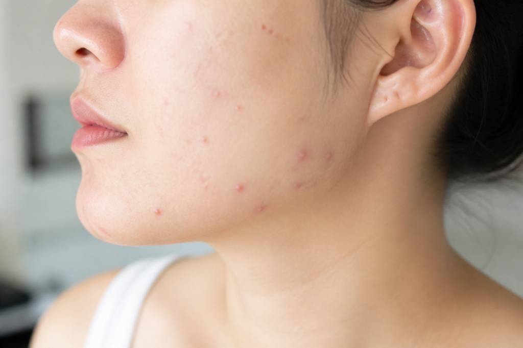 Bobos : causes, traitements et conseils pour les soulager efficacement